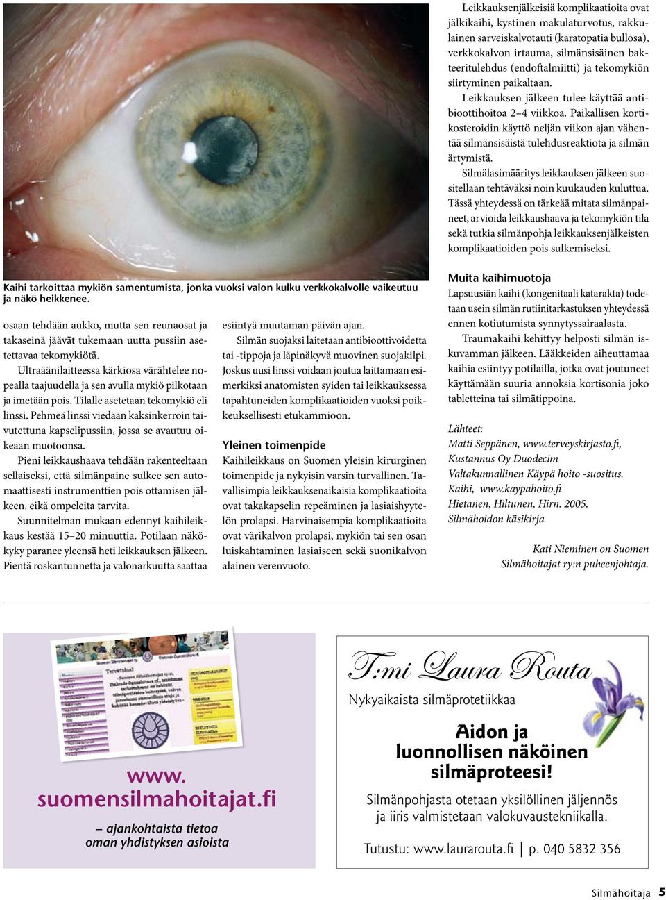 Paikallisen kortikosteroidin käyttö neljän viikon ajan vähentää silmänsisäistä tulehdusreaktiota ja silmän ärtymistä.