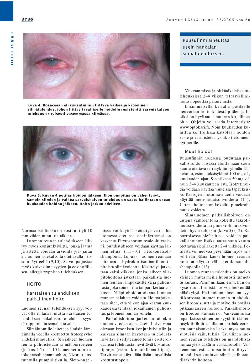 Kuva 5: Kuvan 4 potilas hoidon jälkeen. Ihon punoitus on vähentynyt, samoin silmien ja vaikea sarveiskalvon tulehdus on saatu hallintaan usean kuukauden hoidon jälkeen. Hoito jatkuu edelleen.