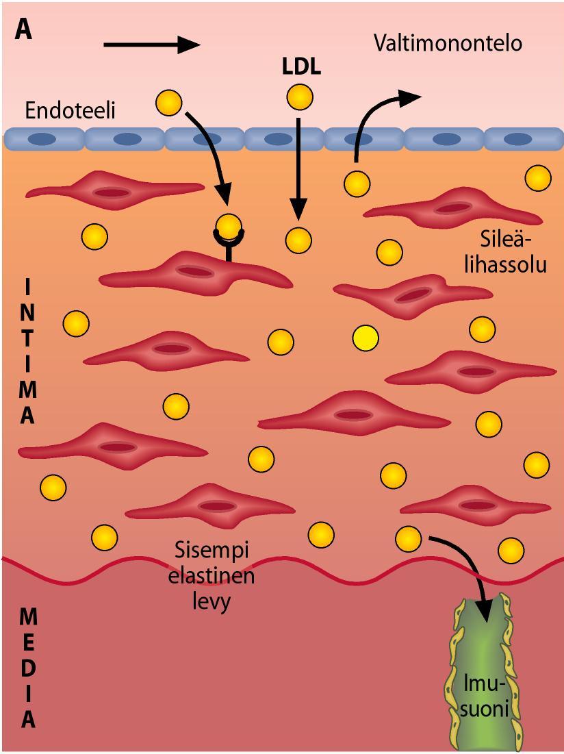 Hemodynamiikan merkitys Koronaariateroskleroosiin kehittyy sinne, mihin kertyy -kolesterolia Stary H, Atlas of Atherosclerosis Ateroskleroosin kehityskulku: (AHA-luokitus) Rasvan kertyminen dominoi