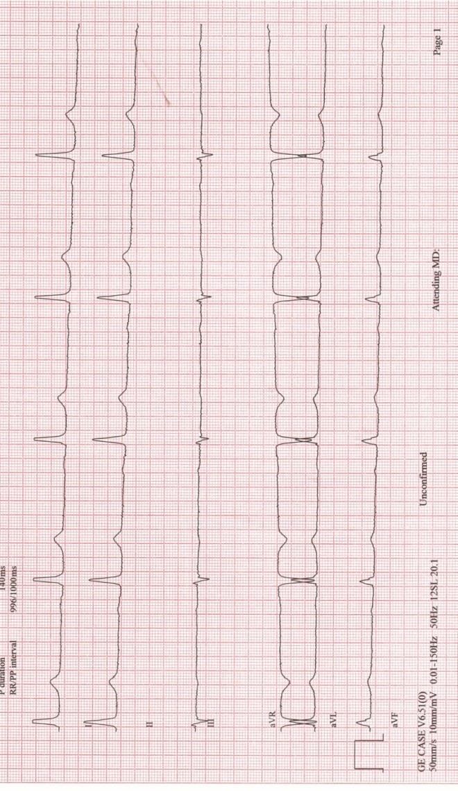 27 Kuvio 6. Paljon perustasonvaellushäiriötä EKG-käyräaineistossa. Vaihtovirtahäiriön esiintyminen hoitajien rekisteröimissä EKG-käyrissä.