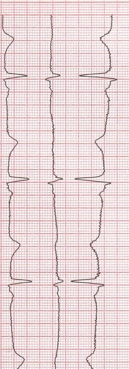 28 Tarkastelussa havaittiin, että vaihtovirtahäiriötä oli osassa EKG-käyristä sekä raaja- että rintakytkennöissä. Vaihtovirtahäiriö vaikeuttaa P- ja/tai Q- aaltojen keston ja amplitudin tarkastelua.