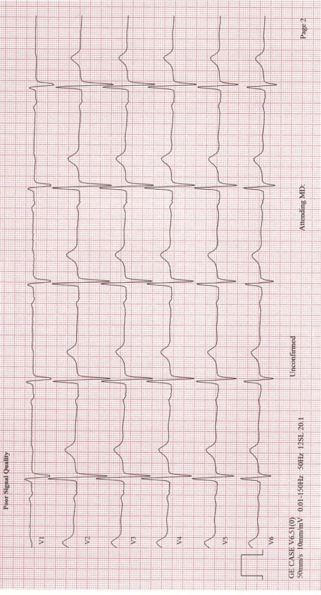 V2 ja V3- käyrän samankaltaisuus kolmessa (n=3) EKG-käyrässä sekä yhdessä (n=1) EKGkäyrässä V5- ja V6- käyrät ovat samankaltaiset. Yhdessä (n=1) EKG-käyrässä V2- ja V4-käyrät samankaltaiset (Kuvio 8.