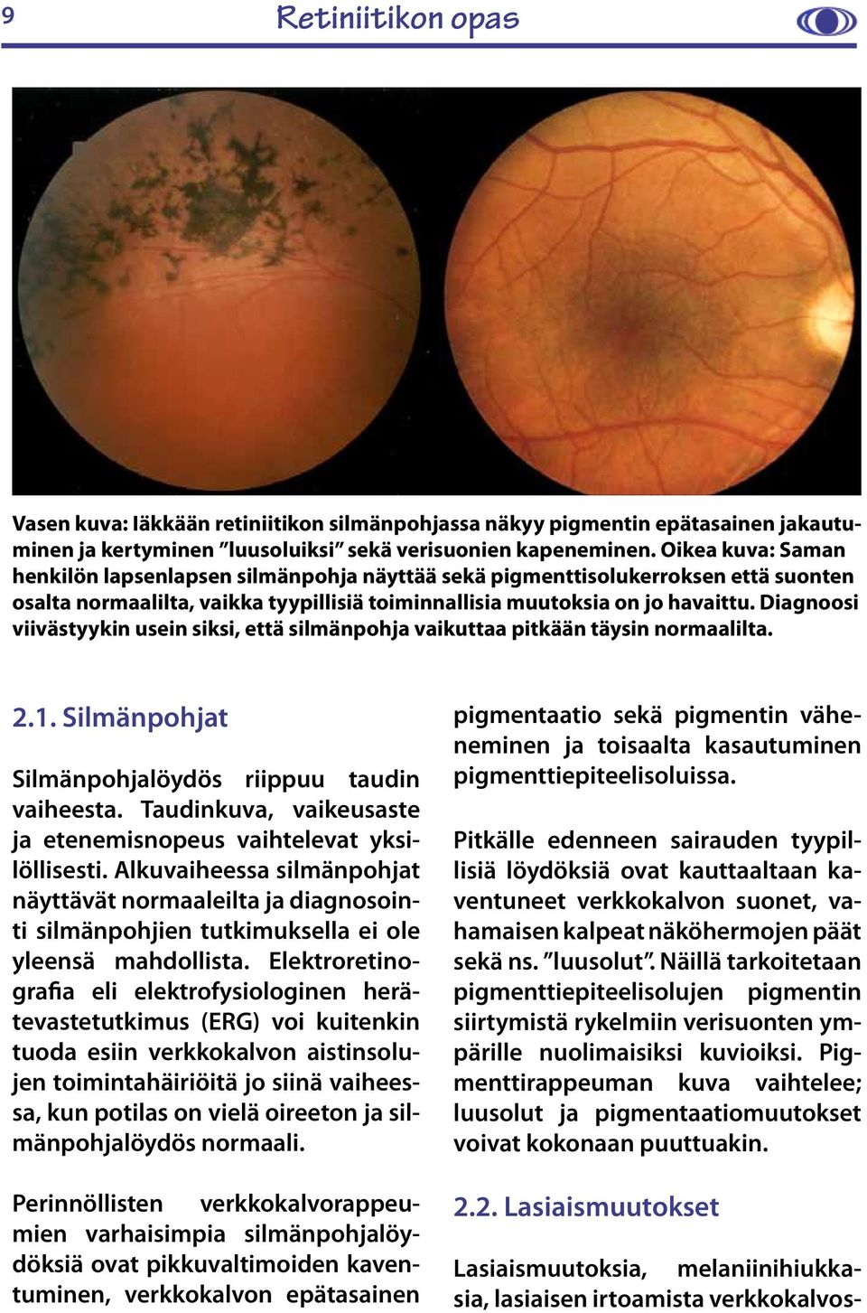Diagnoosi viivästyykin usein siksi, että silmänpohja vaikuttaa pitkään täysin normaalilta. 2.1. Silmänpohjat Silmänpohjalöydös riippuu taudin vaiheesta.