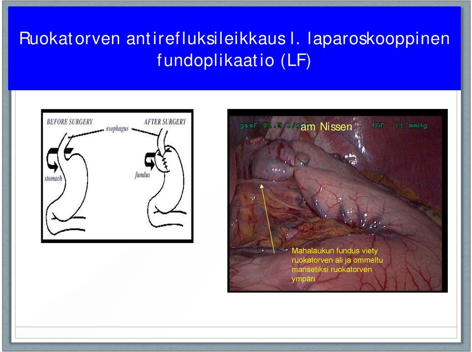 Nissen Mahalaukun fundus viety