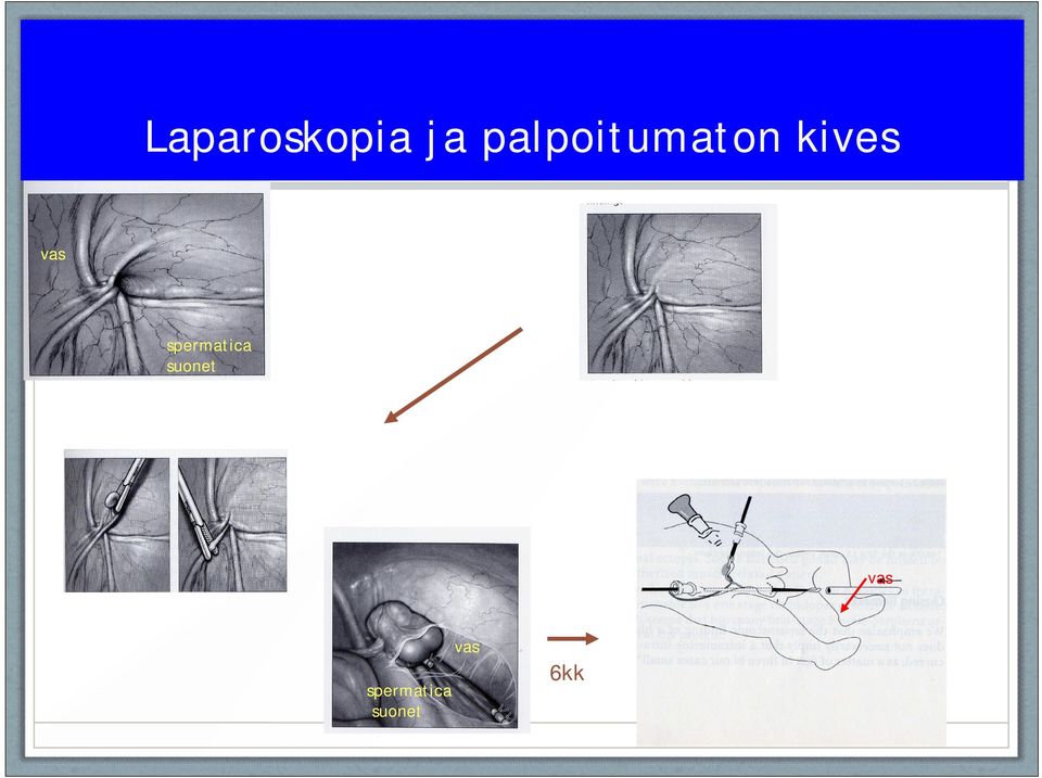 vas spermatica suonet