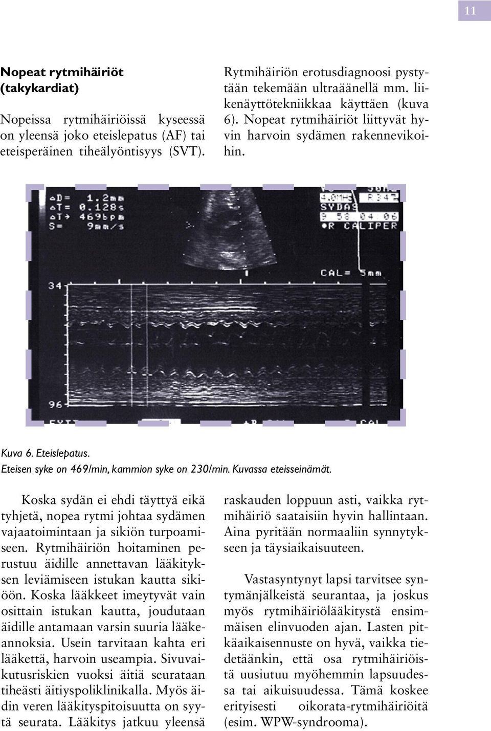 Eteisen syke on 469/min, kammion syke on 230/min. Kuvassa eteisseinämät. Koska sydän ei ehdi täyttyä eikä tyhjetä, nopea rytmi johtaa sydämen vajaatoimintaan ja sikiön turpoamiseen.