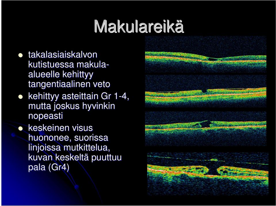 mutta joskus hyvinkin nopeasti keskeinen visus huononee,