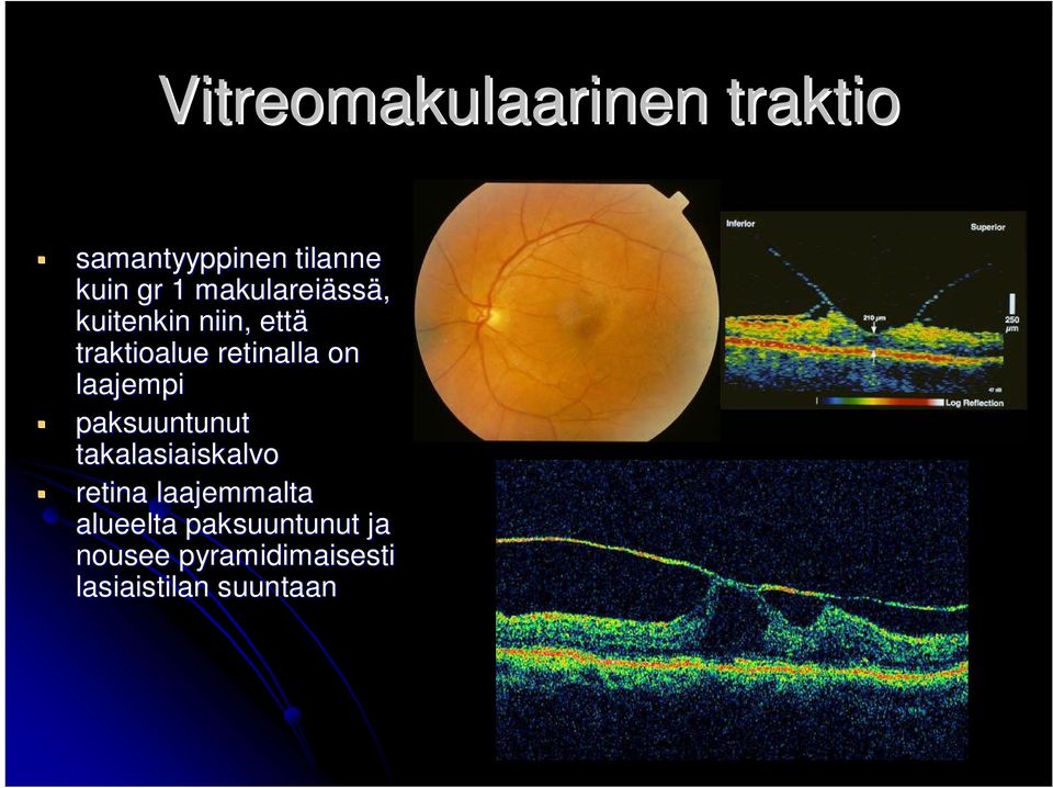 on laajempi paksuuntunut takalasiaiskalvo retina laajemmalta