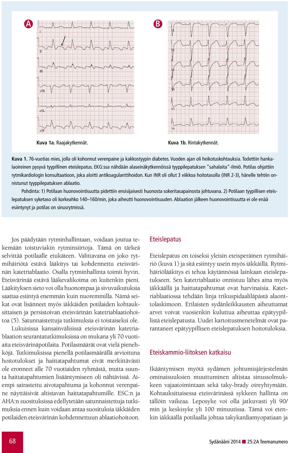 Potilas ohjattiin rytmikardiologin konsultaatioon, joka aloitti antikoagulanttihoidon. Kun INR oli ollut 3 viikkoa hoitotasolla (INR 2-3), hänelle tehtiin onnistunut tyyppilepatuksen ablaatio.