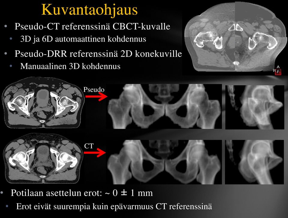 konekuville Manuaalinen 3D kohdennus Pseudo CT Potilaan