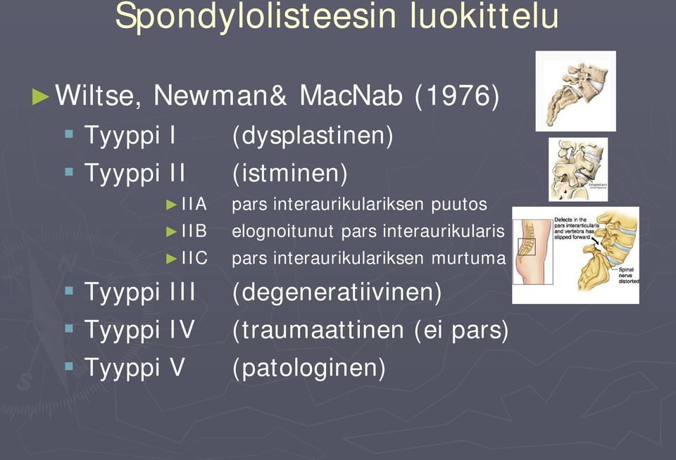 elognoitunut pars interaurikularis IIC pars interaurikulariksen murtuma