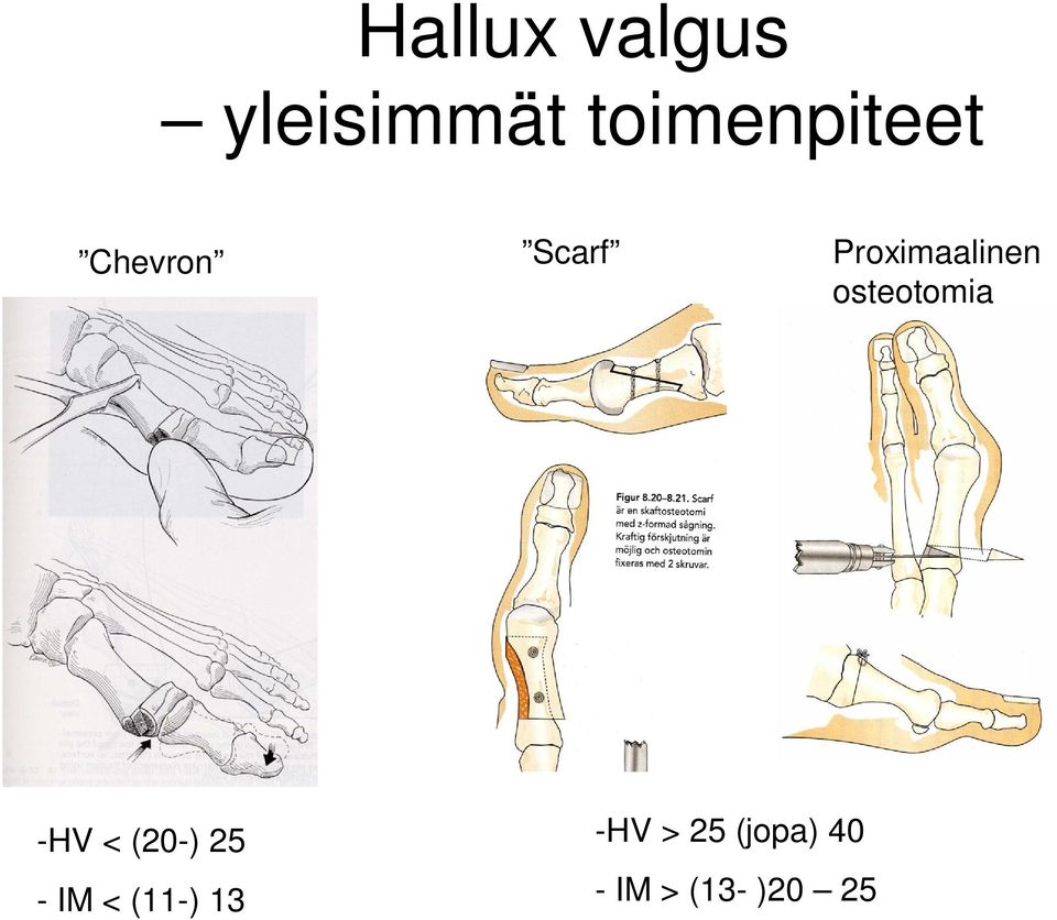 Proximaalinen osteotomia -HV < (20-)
