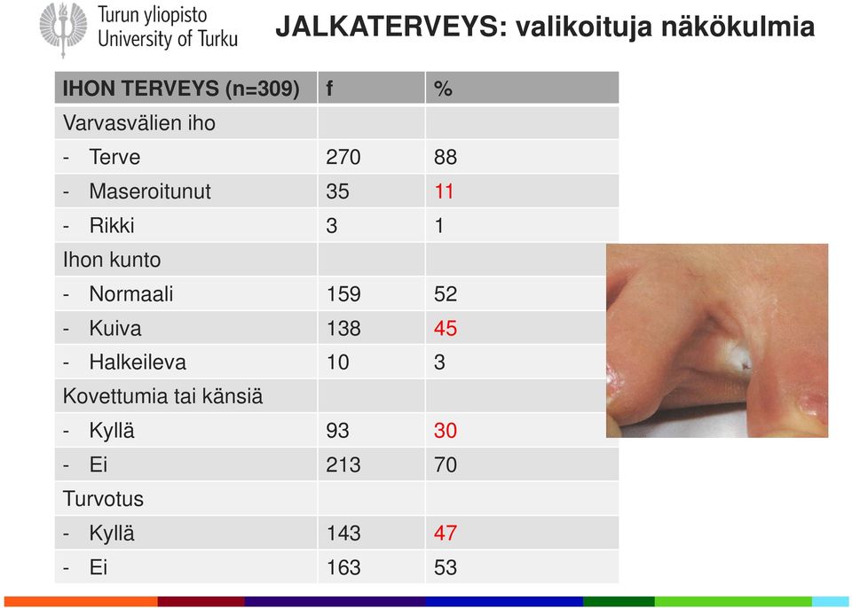 138 45 - Halkeileva 10 3 Kovettumia tai känsiä - Kyllä 93 30 - Ei