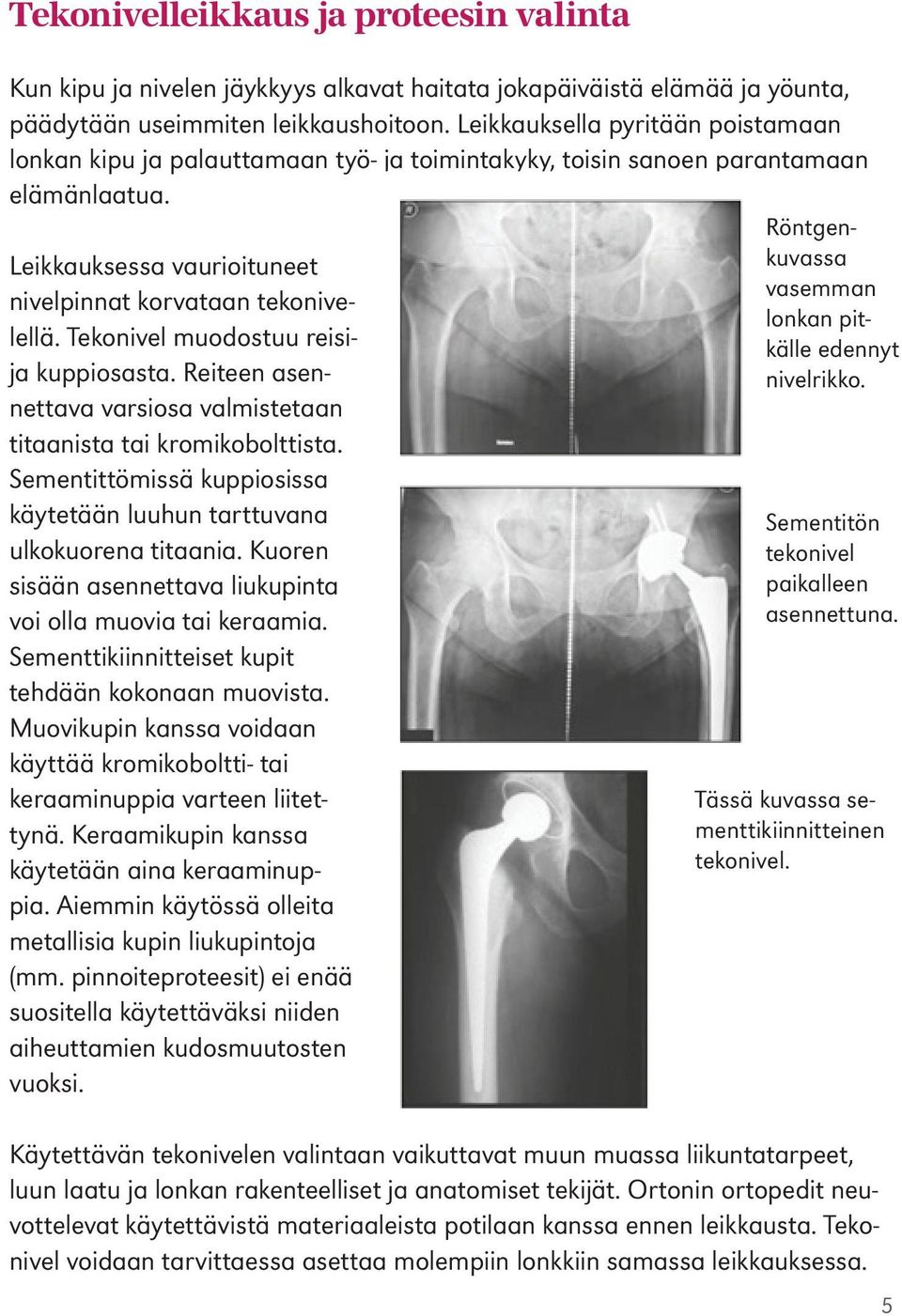 Tekonivel muodostuu reisija kuppiosasta. Reiteen asennettava varsiosa valmistetaan titaanista tai kromikobolttista. Sementittömissä kuppiosissa käytetään luuhun tarttuvana ulkokuorena titaania.