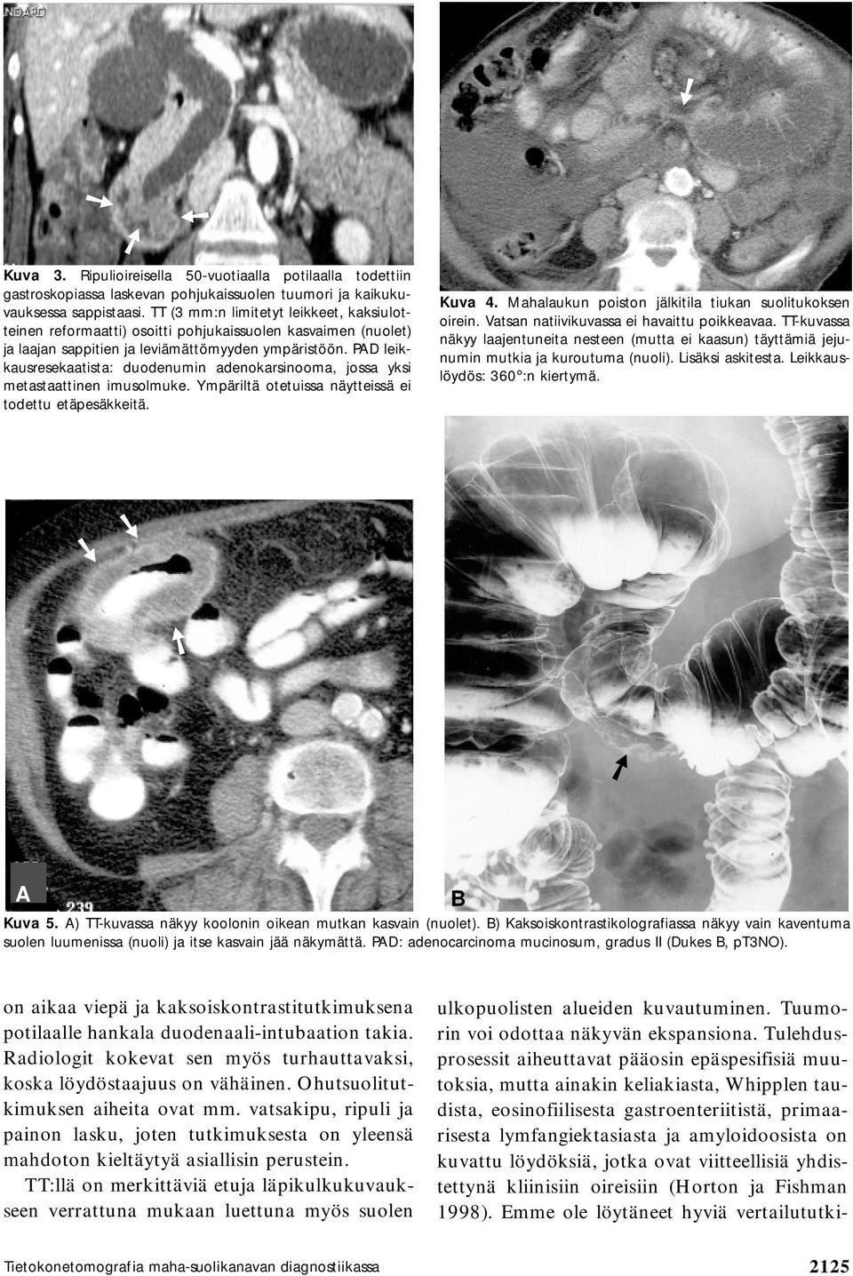 PD leikkausresekaatista: duodenumin adenokarsinooma, jossa yksi metastaattinen imusolmuke. Ympäriltä otetuissa näytteissä ei todettu etäpesäkkeitä. Kuva 4.