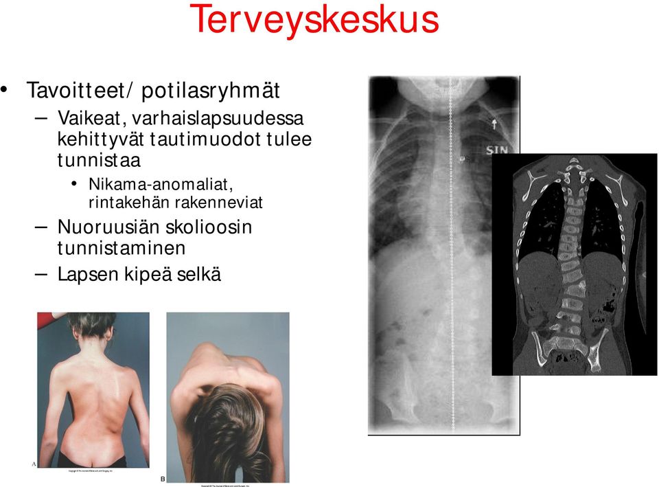 tunnistaa Nikama-anomaliat, rintakehän rakenneviat