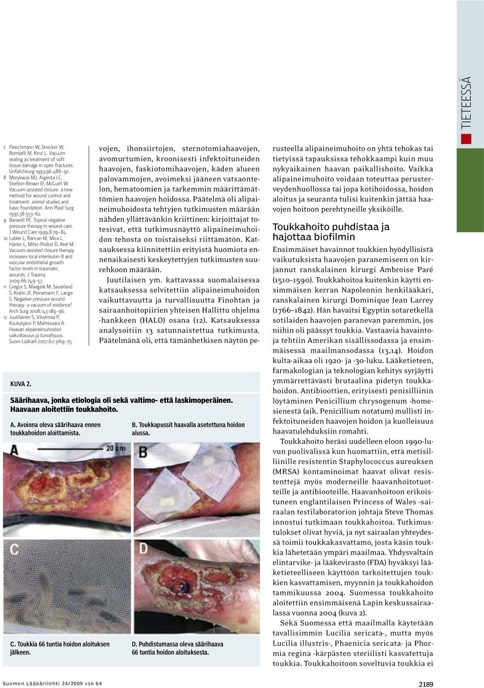 9 Banwell PE. Topical negative pressure therapy in wound care. J Wound Care 1999;8:79 84. 10 Labler L, Rancan M, Mica L, Härter L, Mihic-Probst D, Keel M.