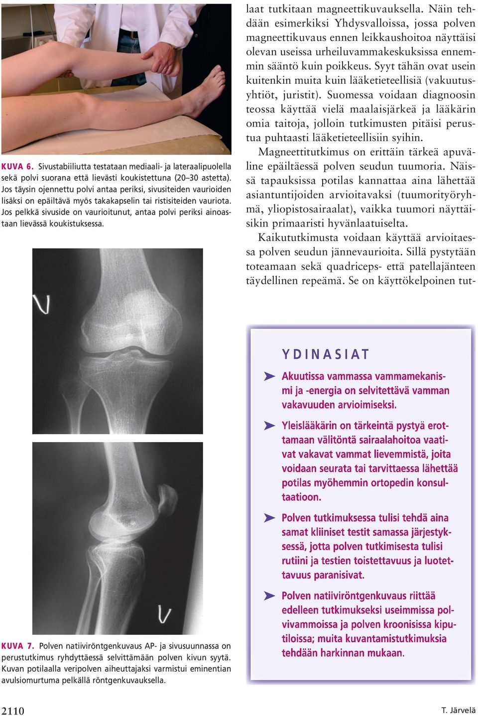 Jos pelkkä sivuside on vaurioitunut, antaa polvi periksi ainoastaan lievässä koukistuksessa. laat tutkitaan magneettikuvauksella.