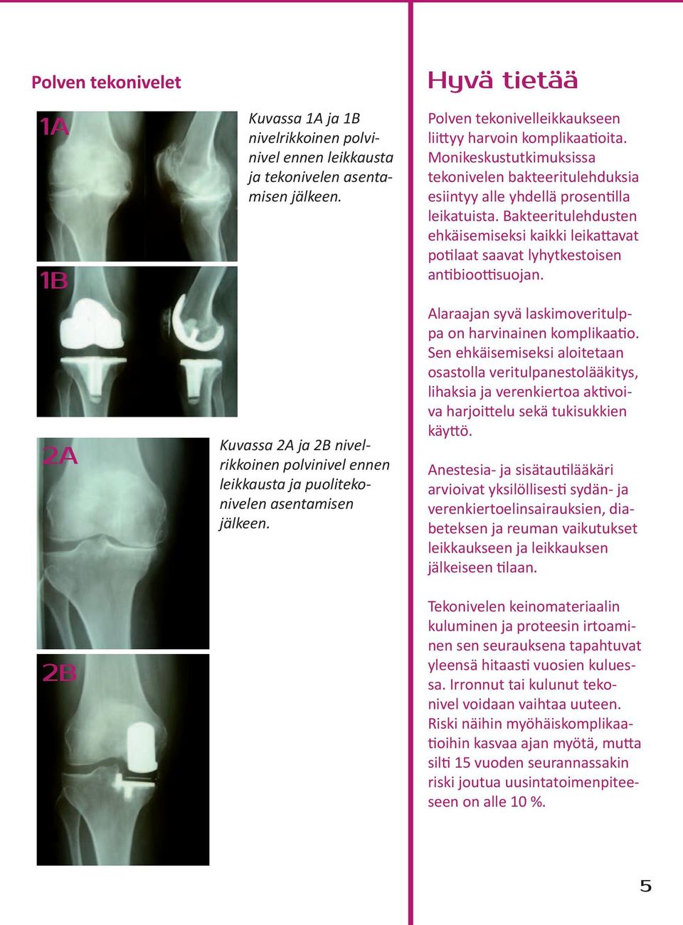 Monikeskustutkimuksissa tekonivelen bakteeritulehduksia esiintyy alle yhdellä prosentilla leikatuista.