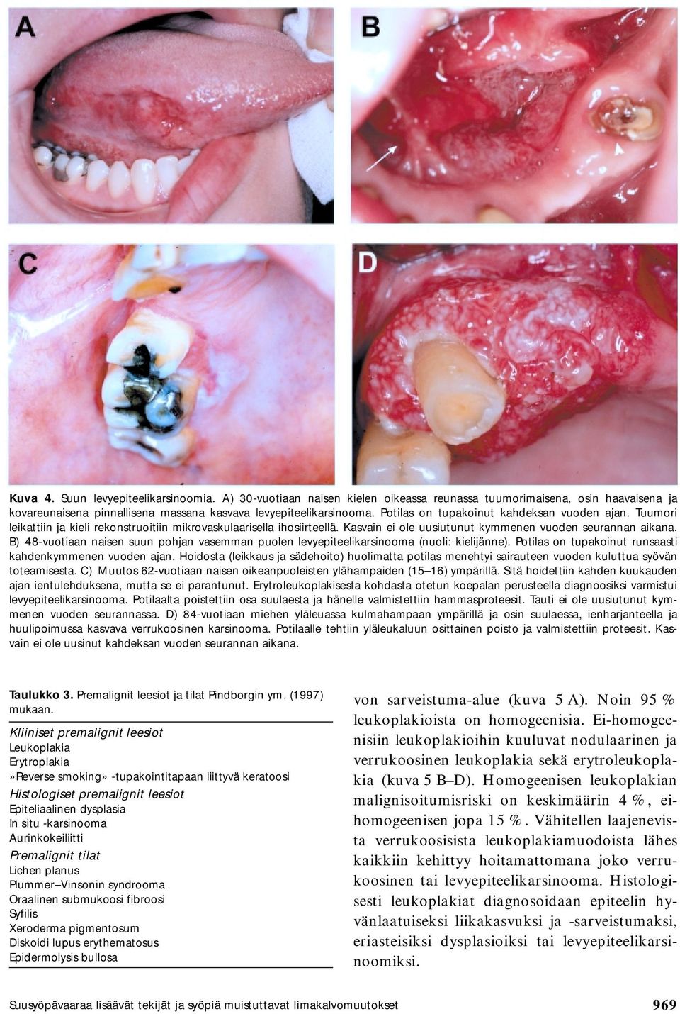 B) 48-vuotiaan naisen suun pohjan vasemman puolen levyepiteelikarsinooma (nuoli: kielijänne). Potilas on tupakoinut runsaasti kahdenkymmenen vuoden ajan.