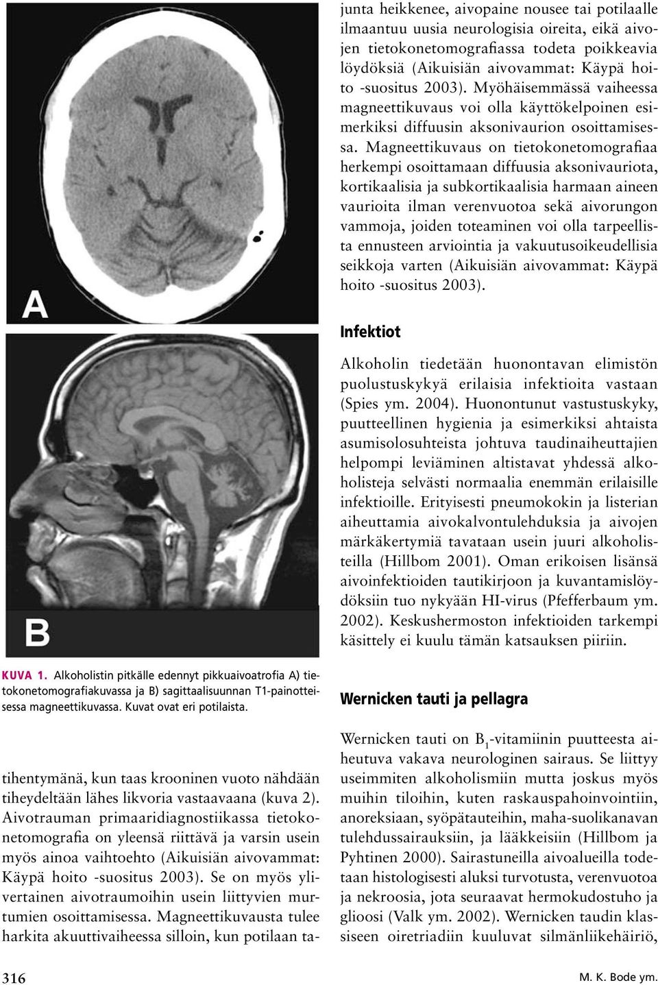 Magneettikuvaus on tietokonetomografiaa herkempi osoittamaan diffuusia aksonivauriota, kortikaalisia ja subkortikaalisia harmaan aineen vaurioita ilman verenvuotoa sekä aivorungon vammoja, joiden