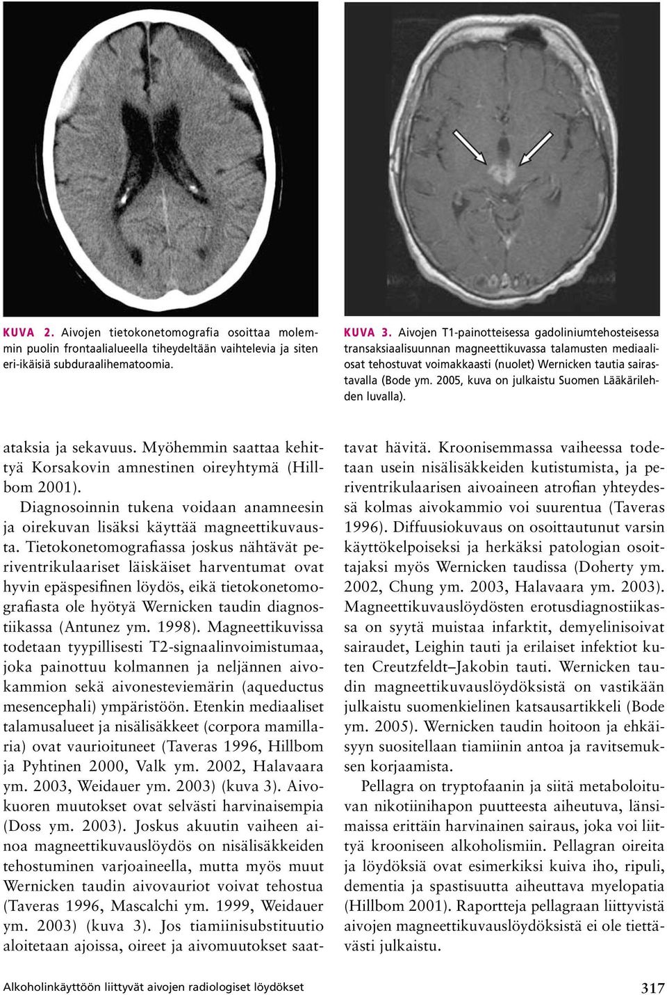 2005, kuva on julkaistu Suomen Lääkärilehden luvalla). Alkoholinkäyttöön liittyvät aivojen radiologiset löydökset ataksia ja sekavuus.