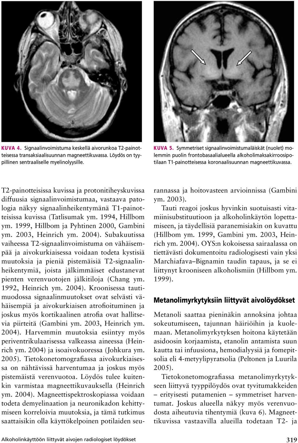 Alkoholinkäyttöön liittyvät aivojen radiologiset löydökset T2 painotteisissa kuvissa ja protonitiheyskuvissa diffuusia signaalinvoimistumaa, vastaava patologia näkyy signaalinheikentymänä T1