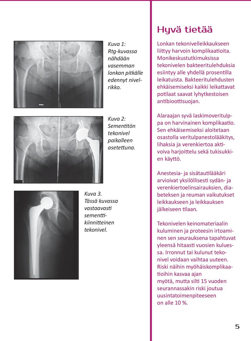 kiinnitteinen tekonivel. Hyvä tietää Hyvä tietää Lonkan Lonkan tekonivelleikkaukseen tekonivelleikkaukseen liittyy liittyy harvoin harvoin komplikaatioita.