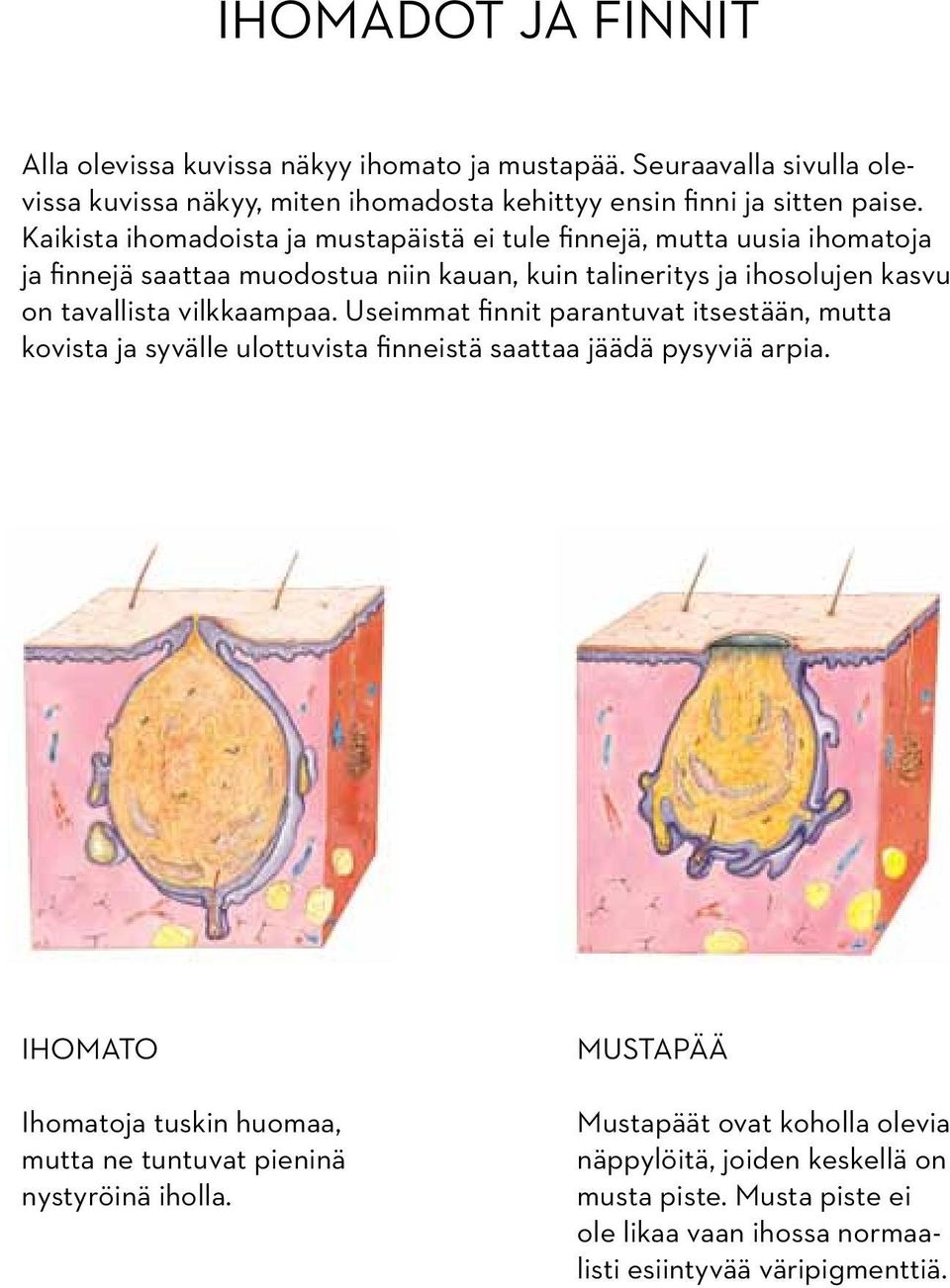 vilkkaampaa. Useimmat finnit parantuvat itsestään, mutta kovista ja syvälle ulottuvista finneistä saattaa jäädä pysyviä arpia.