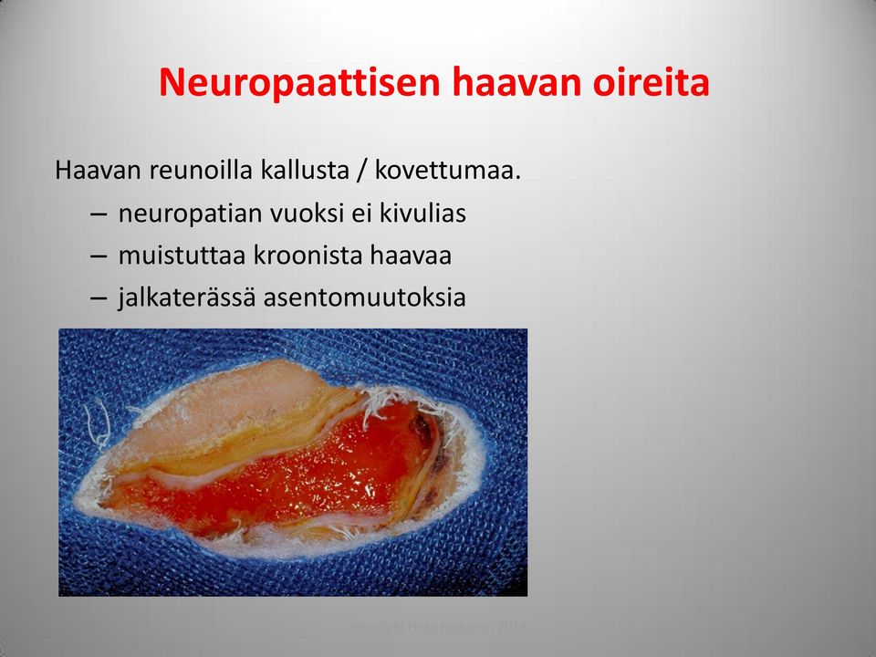 neuropatian vuoksi ei kivulias