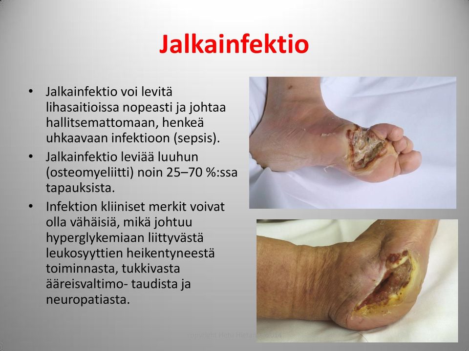 Jalkainfektio leviää luuhun (osteomyeliitti) noin 25 70 %:ssa tapauksista.