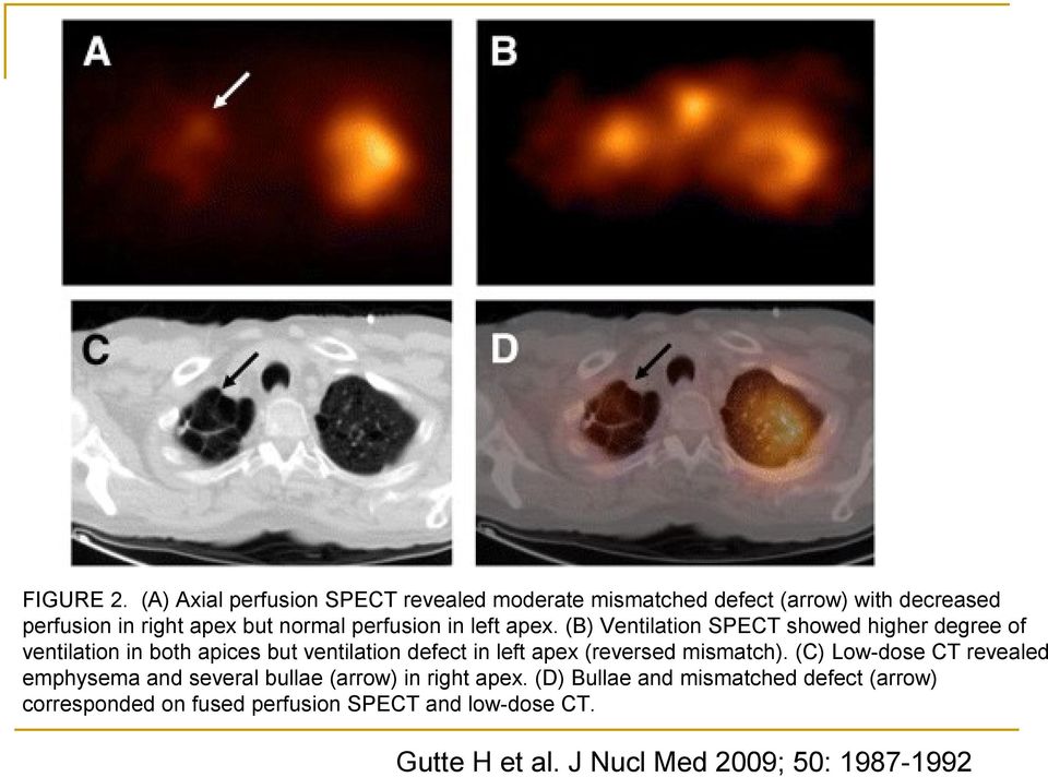 perfusion in left apex.