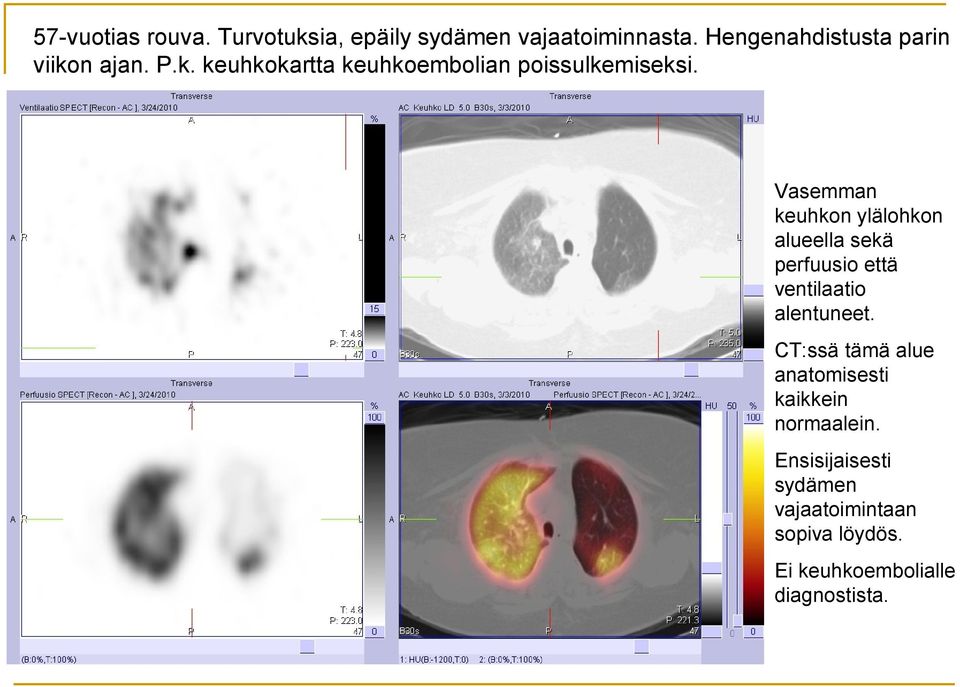 Vasemman keuhkon ylälohkon alueella sekä perfuusio että ventilaatio alentuneet.