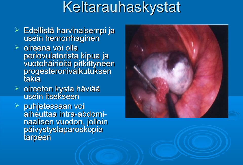 progesteronivaikutuksen takia oireeton kysta häviää usein itsekseen