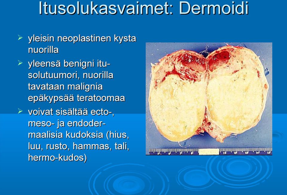 epäkypsää teratoomaa voivat sisältää ecto-, meso- ja endoder-