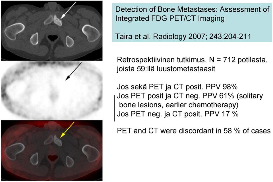 luustometastaasit Jos sekä PET ja CT posit. PPV 98% Jos PET posit ja CT neg.