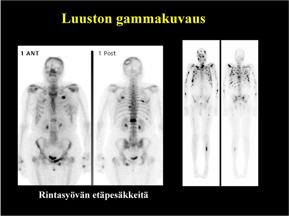 Rintasyövän