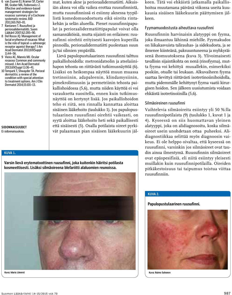 Management of facial erythema of rosacea: What is the role of topical a-adrenergic receptor agonist therapy? J Am Acad Dermatol 2013;69(Suppl 1):44 56. 9 Vieira AC, Mannis MJ.