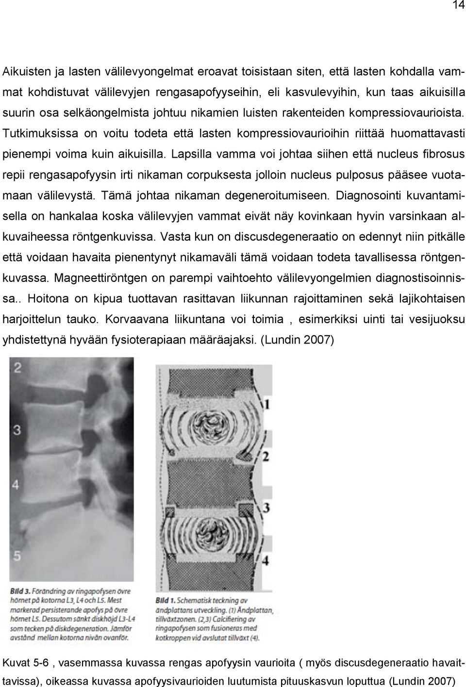 Lapsilla vamma voi johtaa siihen että nucleus fibrosus repii rengasapofyysin irti nikaman corpuksesta jolloin nucleus pulposus pääsee vuotamaan välilevystä. Tämä johtaa nikaman degeneroitumiseen.