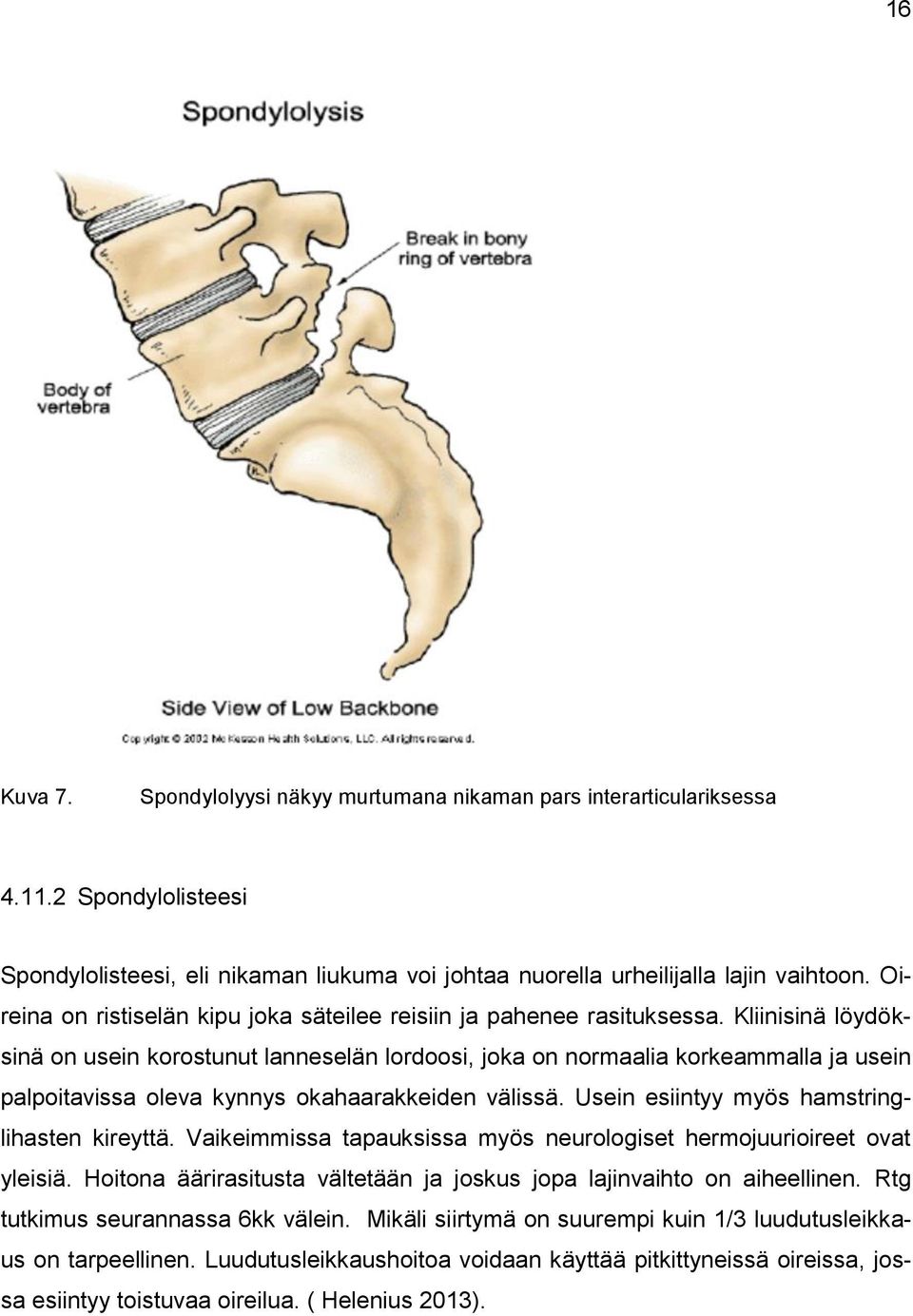 Kliinisinä löydöksinä on usein korostunut lanneselän lordoosi, joka on normaalia korkeammalla ja usein palpoitavissa oleva kynnys okahaarakkeiden välissä.