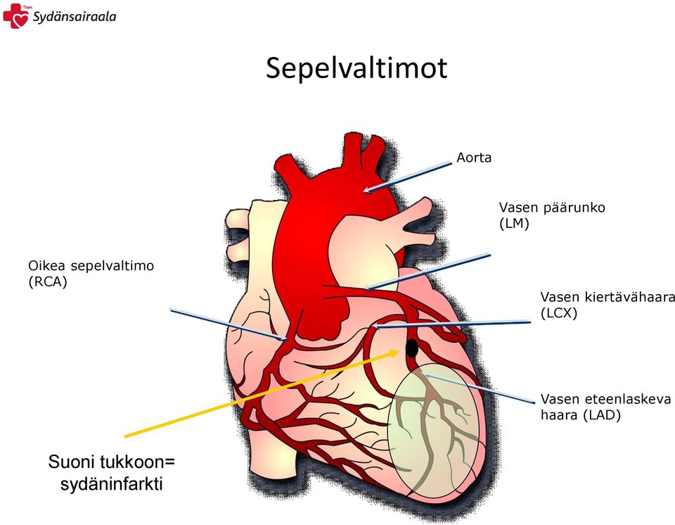 kiertävähaara (LCX) Vasen