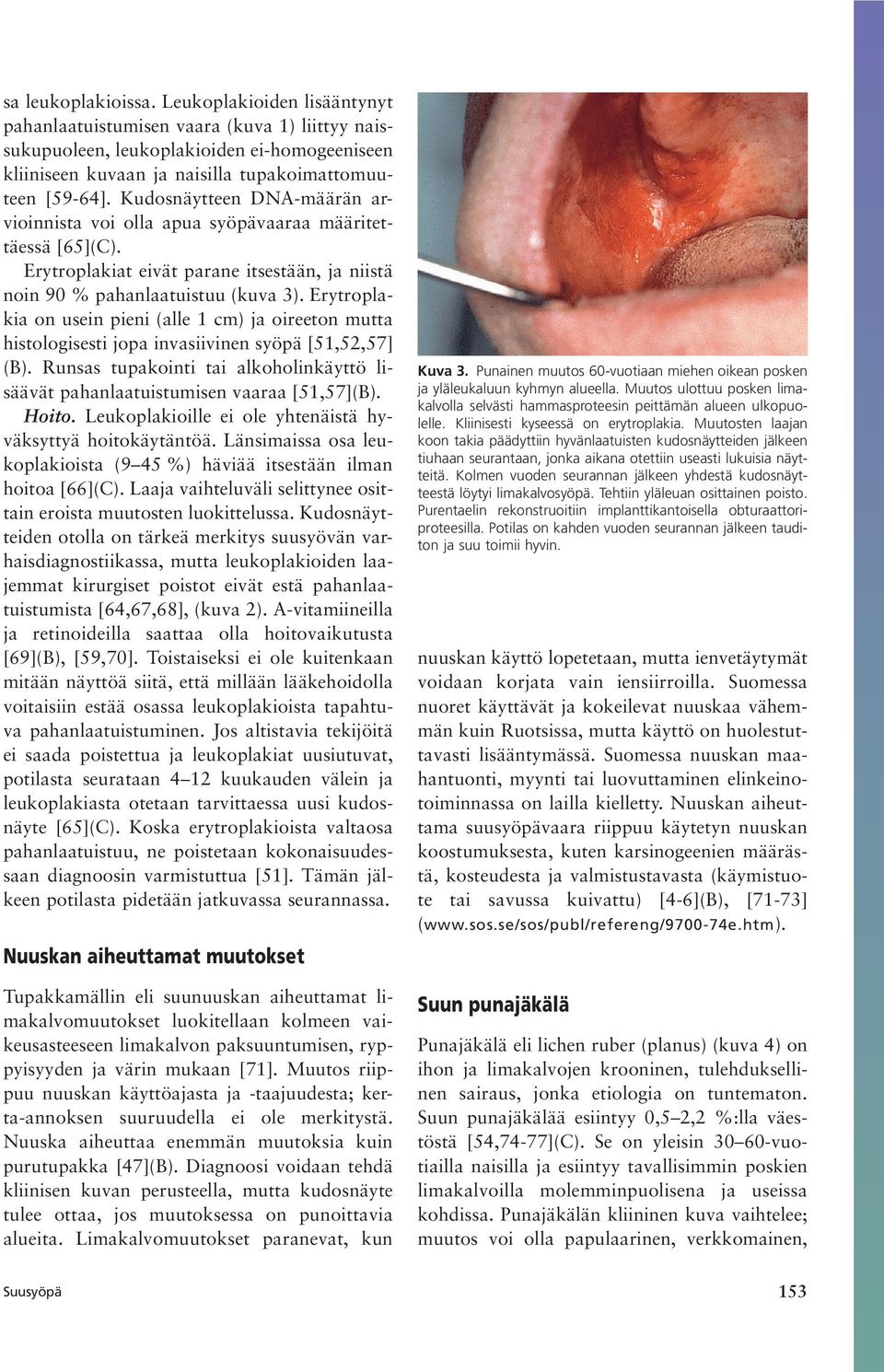 Erytroplakia on usein pieni (alle 1 cm) ja oireeton mutta histologisesti jopa invasiivinen syöpä [51,52,57] (B). Runsas tupakointi tai alkoholinkäyttö lisäävät pahanlaatuistumisen vaaraa [51,57](B).