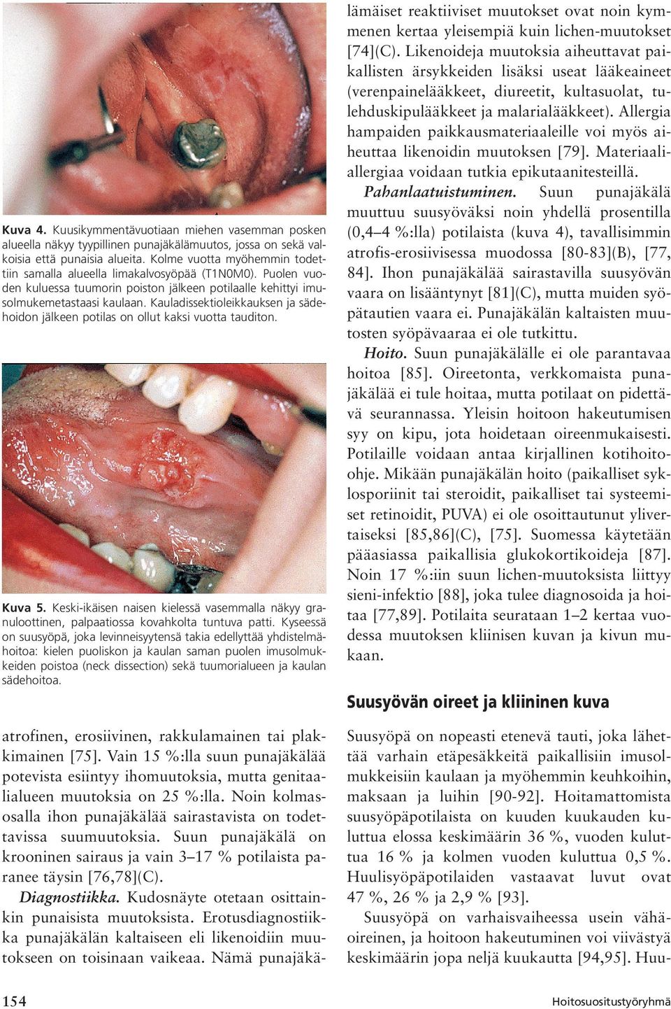 Kauladissektioleikkauksen ja sädehoidon jälkeen potilas on ollut kaksi vuotta tauditon. Kuva 5. Keski-ikäisen naisen kielessä vasemmalla näkyy granuloottinen, palpaatiossa kovahkolta tuntuva patti.