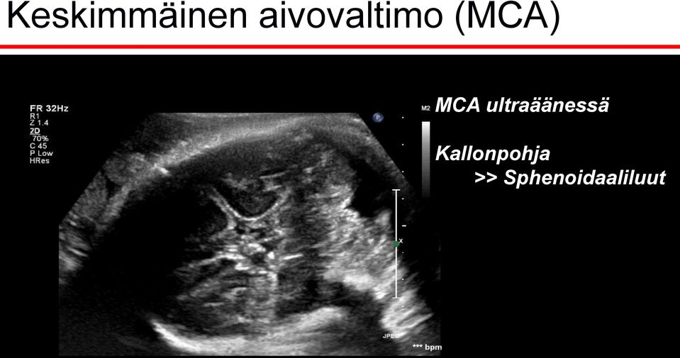 MCA ultraäänessä