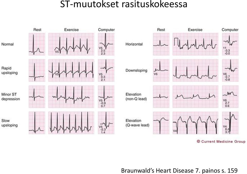 Braunwald s Heart