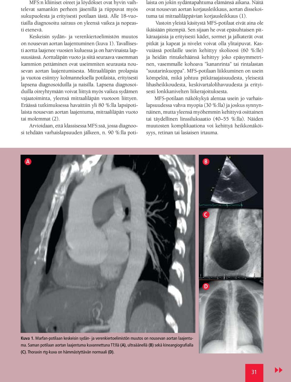Tavallisesti aortta laajenee vuosien kuluessa ja on harvinaista lapsuusiässä. Aorttaläpän vuoto ja siitä seuraava vasemman kammion pettäminen ovat useimmiten seurausta nousevan aortan laajentumisesta.