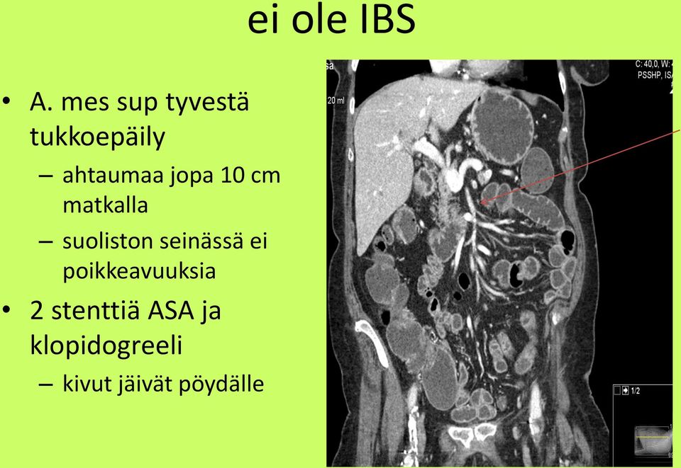 jopa 10 cm matkalla suoliston seinässä