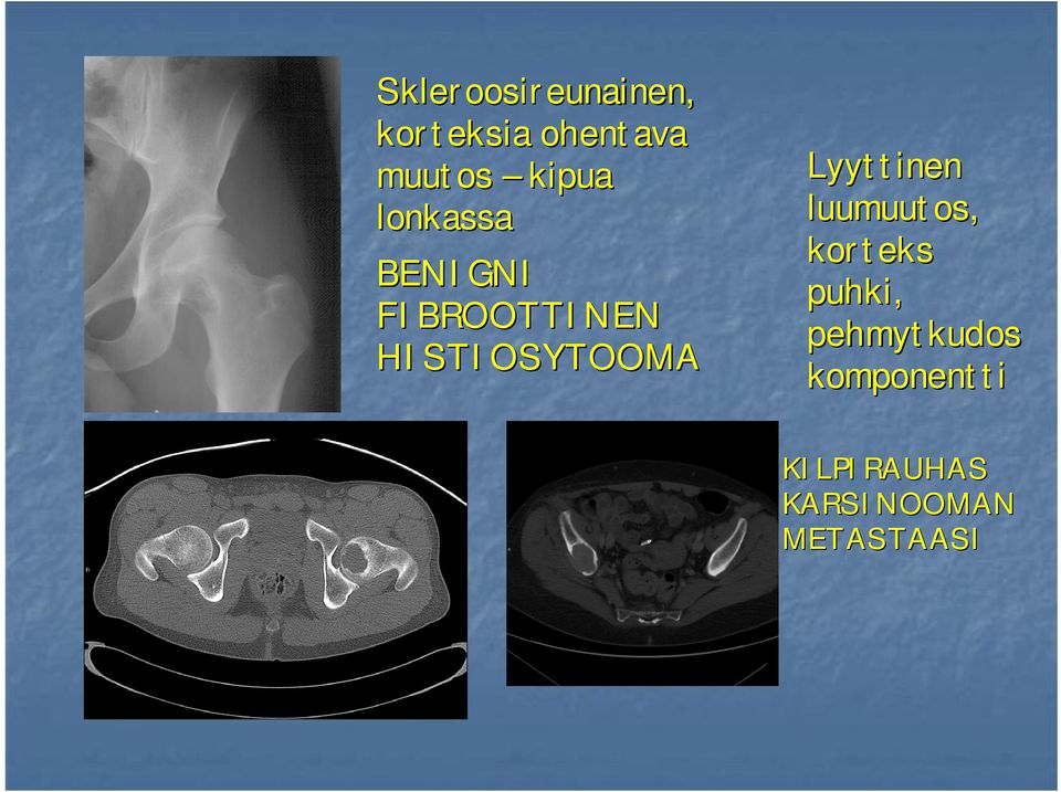 HISTIOSYTOOMA Lyyttinen luumuutos, korteks