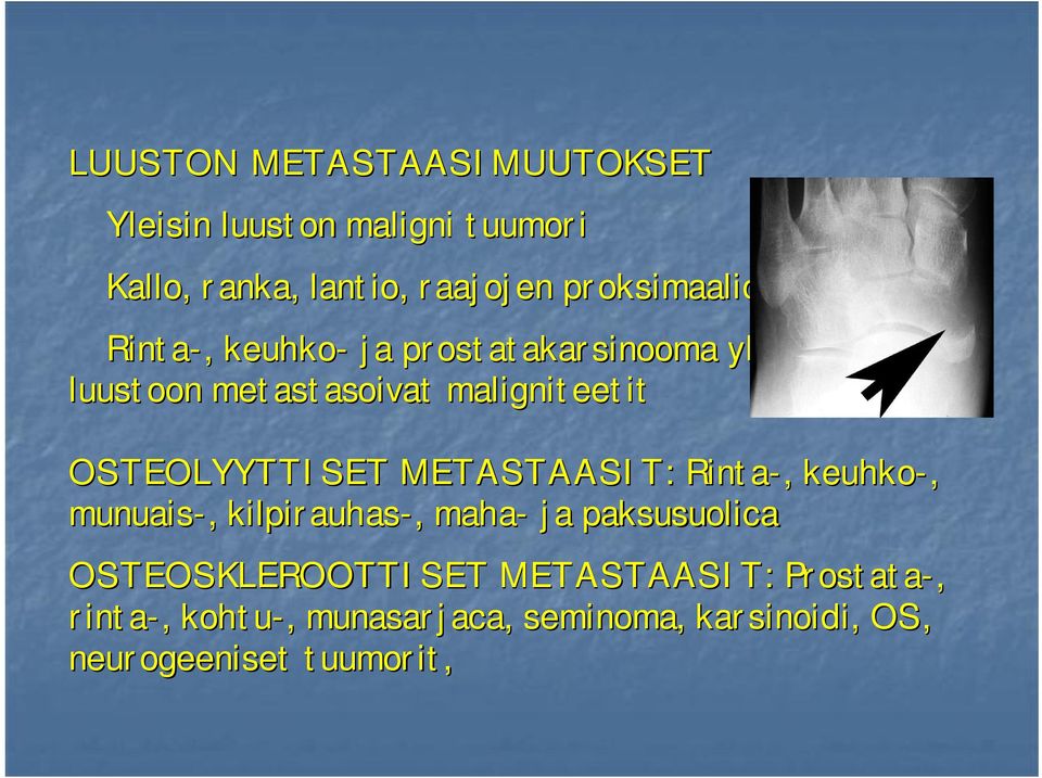 OSTEOLYYTTISET METASTAASIT: Rinta-,, keuhko-, munuais-,, kilpirauhas-,, maha- ja paksusuolica