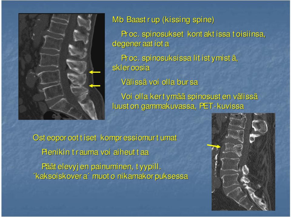 spinosusten välissä luuston gammakuvassa, PET-kuvissa Osteoporoottiset kompressiomurtumat